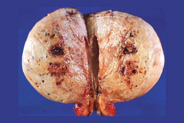 Laparoscopic image of the uterus with adenomyosis