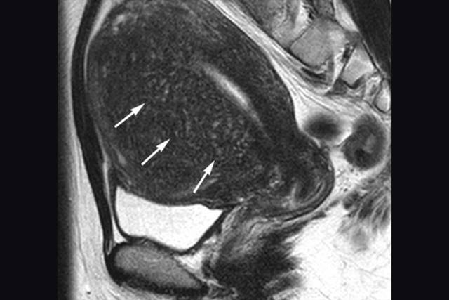 MRI Image of Focal Uterine Adenomyosis