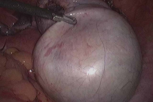 Dermoid cyst